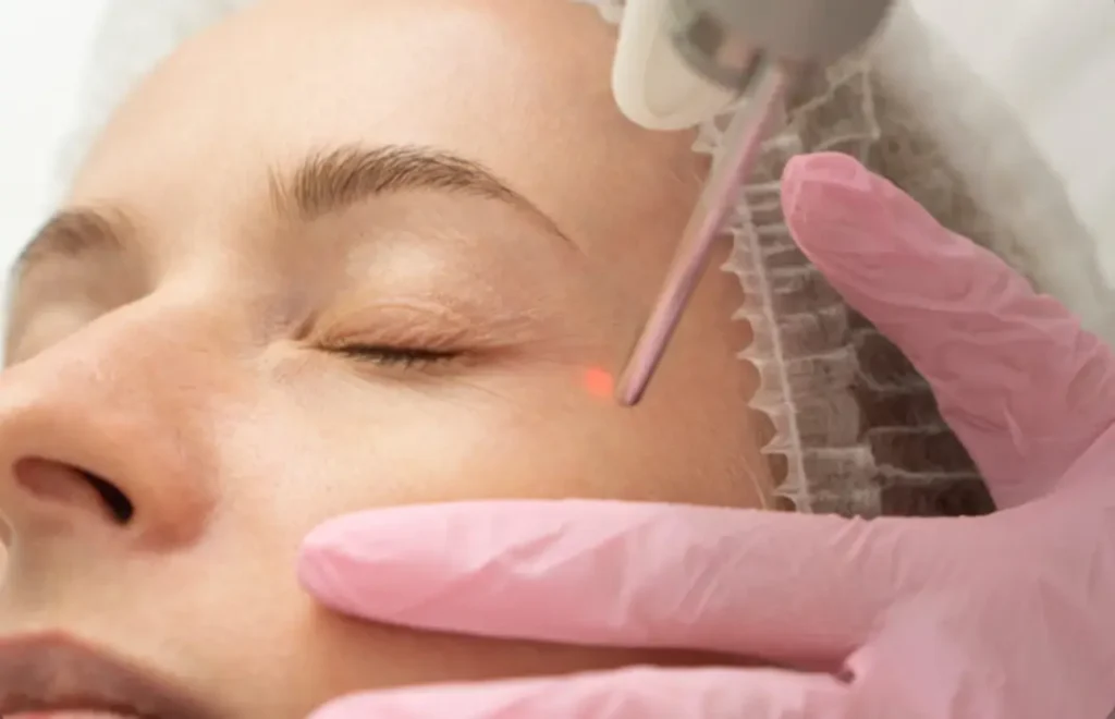 skuteczność zabiegu zamykania naczynek